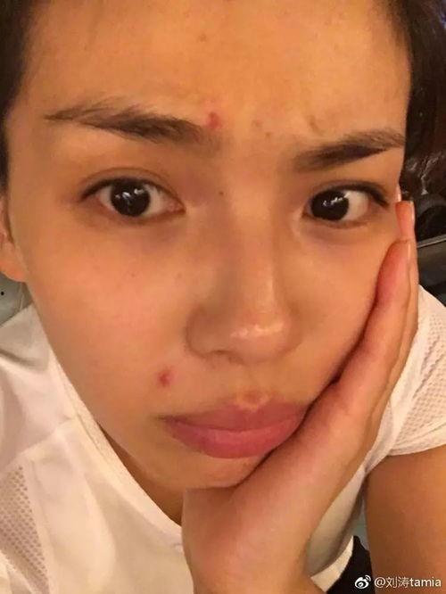 女明星 长痘,战痘成功，美丽依旧